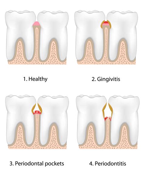 Stages Of Gum Disease Lake Jackson Tx Bell Dental