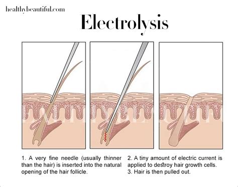 Electrolysis Vs Laser Hair Removal The Complete Guide Healthy Beautiful