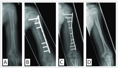 Ewing Sarcoma Of The Humerus Treated With A Vascularized Fibula Graft