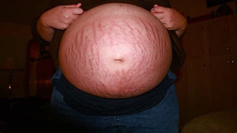 Stretch Mark Common Causes And Natural Remedies Magazines2day