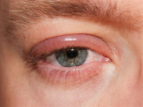 Facts About Conjunctivitis Pink Eye In Older Adults Youmemindbody