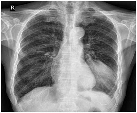 Primary Malignant Melanoma Of Left Lower Lobe Of Lung A Case Report