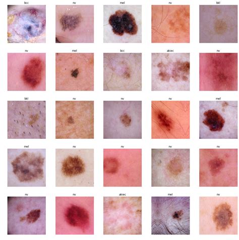 Github Temcavanaghskin Cancer Detection Implementing And Comparing