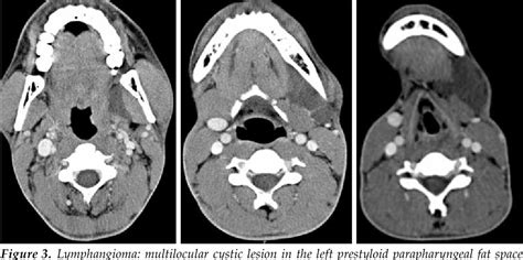 Figure 3 From Imaging Of Cystic Neck Masses In Adults Semantic Scholar