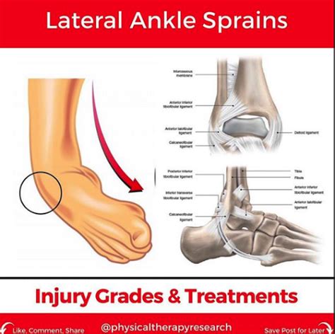 Lateral Ankle Sprains Injury And Treatments Modern Manual Therapy Blog