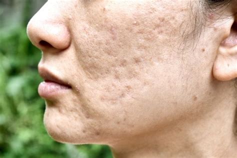 7 Best Ways To Get Rid Of Atrophic Acne Scarring Goodglow