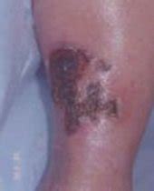 What type of lesion is it? Venous Stasis & Arterial Ulcer Comparison | LHSC