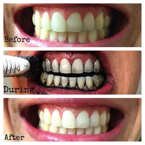 How Does Activated Charcoal Whiten Teeth Dr Chauvin