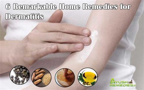 6 Home Remedies For Dermatitis On Face Scalp And Hands