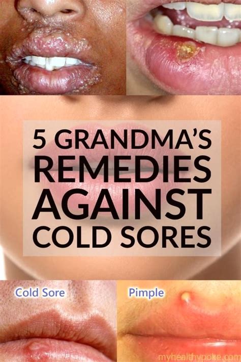 Pin By Potapklevantsev On Skin Care Cold Sore Cold Sores Remedies