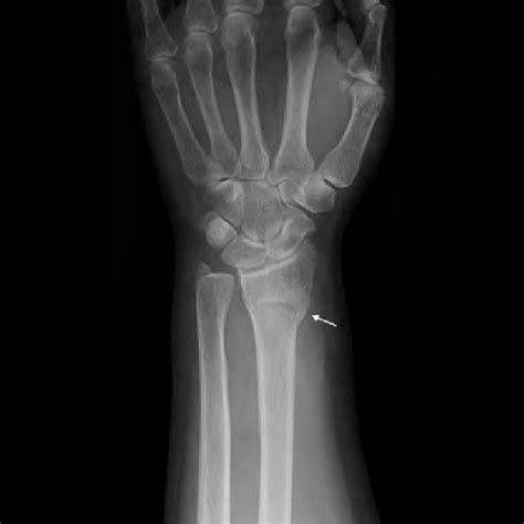 An X Ray Showing Left Distal Radius Fracture Of The Patient Arrow