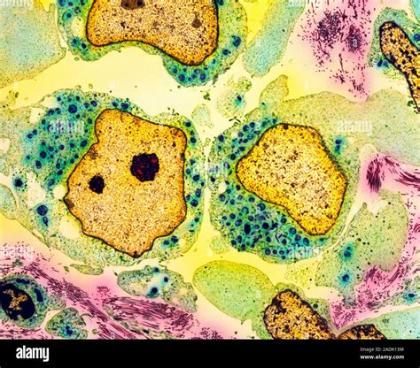 Testicular Cancer Coloured Transmission Electron Micrograph Tem Of A