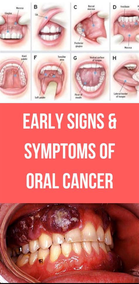 Early Signs And Symptoms Of Oral Cancer Alorabarbie