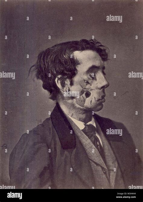 Civil War Facial Wound Stock Photo Alamy