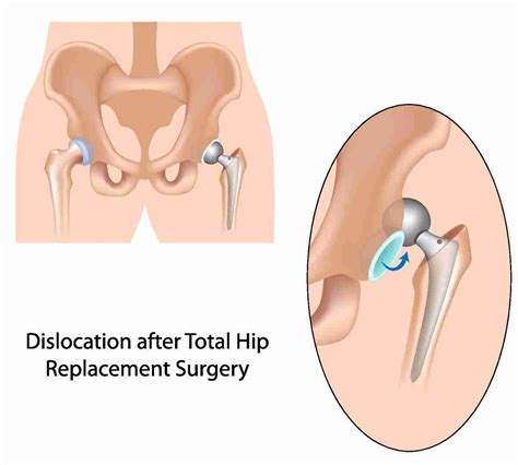 Painful Hip Replacement Causes For Continued Pain