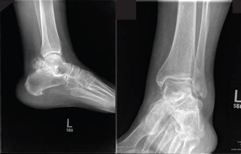 Osteochondromas Of The Subtalar Joint A Case Study The Foot And