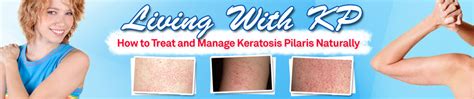 Keratosis Pilaris Treatment Over The Counter Dorothee Padraig South