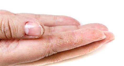 Skin Fungal Infection On Hands