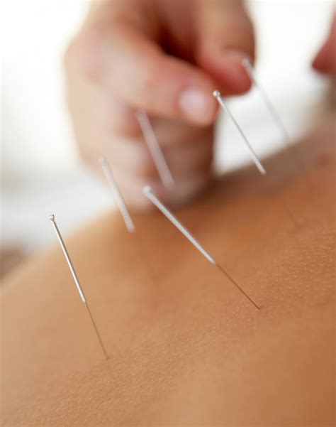 The Benefits Of Acupuncture
