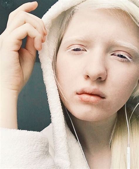 Models With Albinism Who Are Taking The Fashion World By Storm Albino Pinterest
