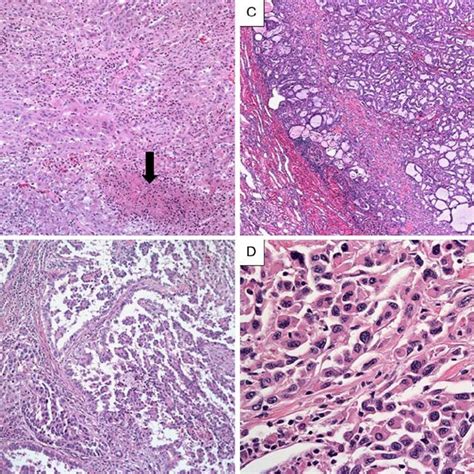 Gross Appearance Of Renal Medullary Carcinoma Grayish White Firm Tumor