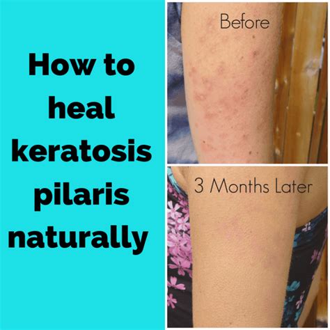 How I Healed My Keratosis Pilaris Kp Naturally Pure And Simple