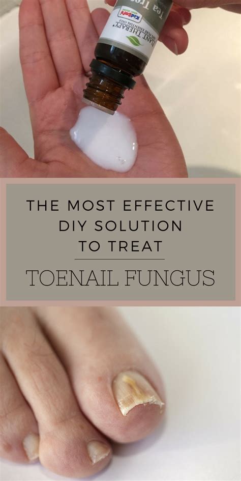 The Most Effective Diy Solution To Treat Toenail Fungus Beauty Area