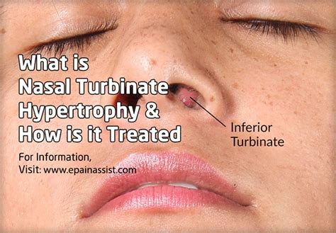 Nasal Turbinate Hypertrophy Vs Normal