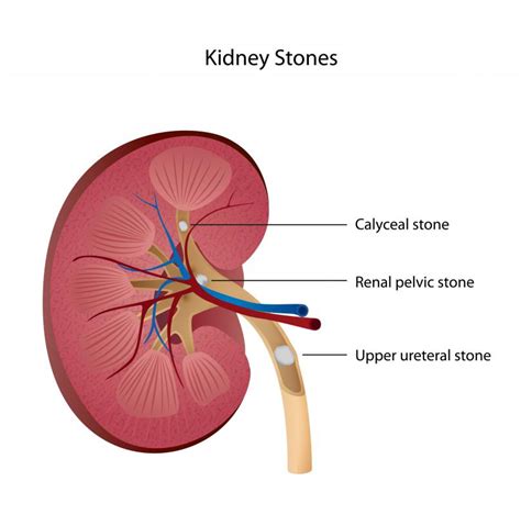 What Are Kidney Stones With Pictures