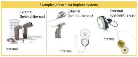 How Do Cochlear Implants Benefit Students With Hearing Loss