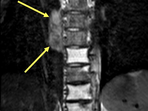 Lymphoma Hodgkin Spine Diagnosis Mri Online