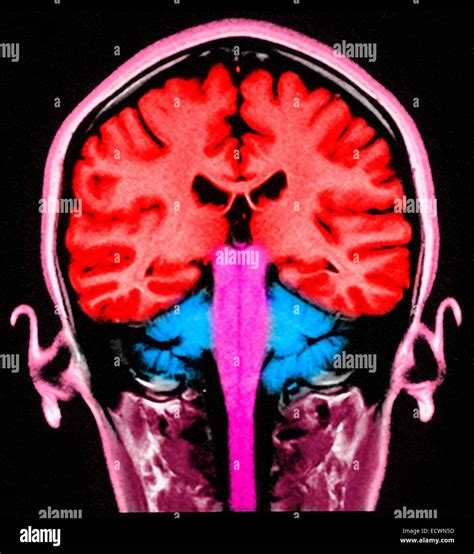 Skull Brain Cross Section Hi Res Stock Photography And Images Alamy