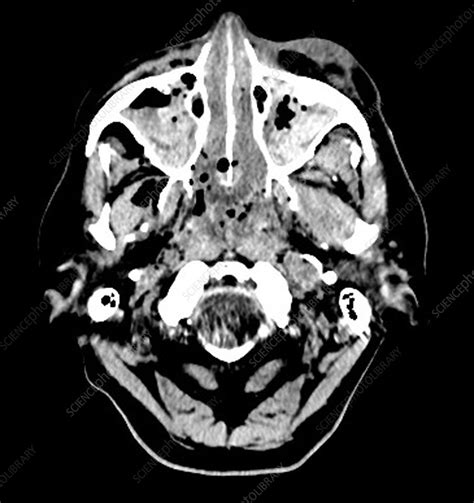 Extensive Traumatic Brain Injury Ct Stock Image C0271679 Science