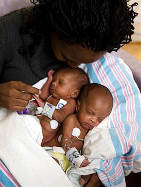Medical Miracle Conjoined Twins Separated In Memphis