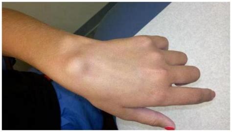 Wrist Swelling