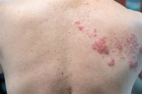 Skin Rash And Blisters On Body Shingles On Men Herpes Zoster Stock Hot Sex Picture