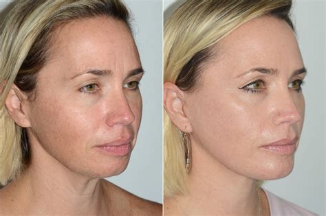Lifting Facial Facelift Fotos Coral Gables FL Paciente