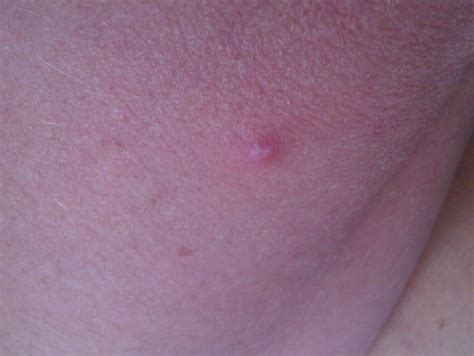 I Have A Small White Lump With Red Around It On My Forearm