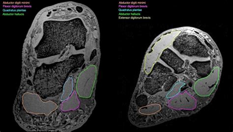 Related posts of foot muscle anatomy mri. Exploration of the deep foot muscles at ultra-high field - National Imaging Facility