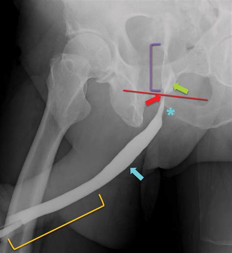Urethrography For Assessment Of The Adult Male Urethra Radiographics Fundamentals Online