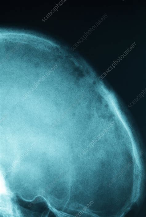 Secondary Bone Cancers X Ray Stock Image M1340532 Science Photo