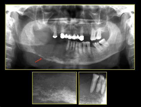 Caso N Carcinoma Epidermoide Evaluaci N Con Tomograf A Volum Trica Cdi Per