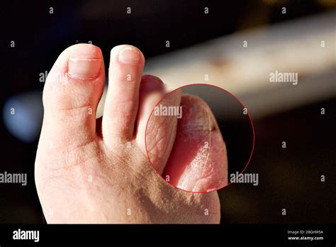 Blisters On Feet Hi Res Stock Photography And Images Alamy