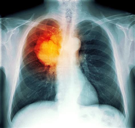 Lung Cancer X Ray Photograph By Du Cane Medical Imaging Ltd Fine Art