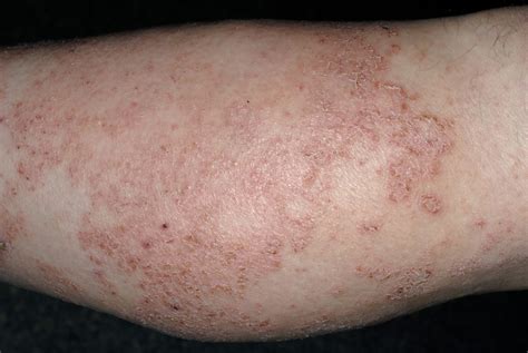 Best Eczema Atopic Dermatitis Images Articles Gold Makeup Gold Hot Sex Picture