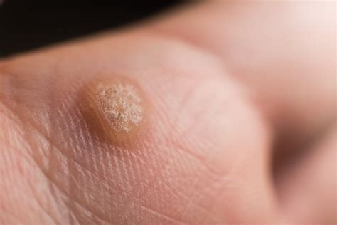 Can You Use Salicylic Acid to Remove Warts? – Procoal