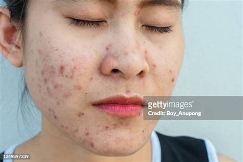 Skin Blisters Face Photos And Premium High Res Pictures Getty Images