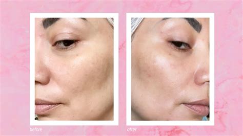 How To Treat Acne Uneven Texture And Large Pores Allure