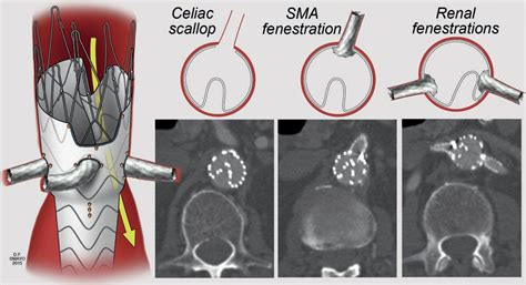 Severe Infolding Of Fenestrated Branched Endovascular Stent Graft