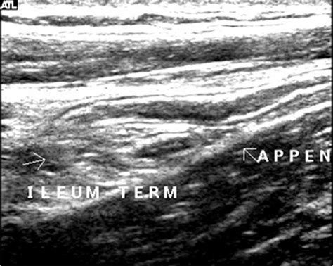 Longitudinal Ultrasound Image Of A Normal Appendix Download